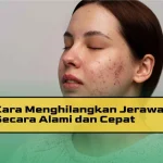 Cara Mengatasi Jerawat Secara Alami: Panduan Lengkap untuk Kulit Sehat