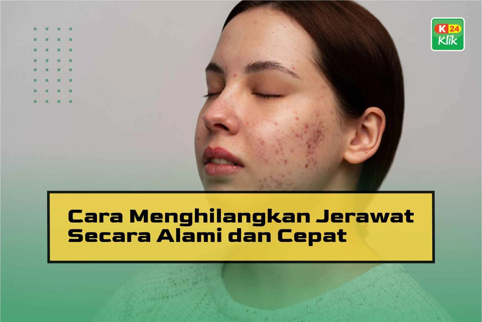 Cara Mengatasi Jerawat Secara Alami Panduan Lengkap Untuk Kulit Sehat